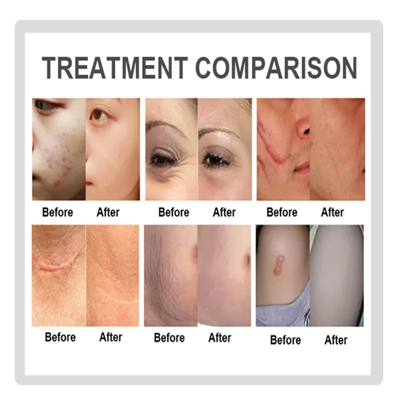 Professional Portable CO2 Fractional Laser Therapy Device